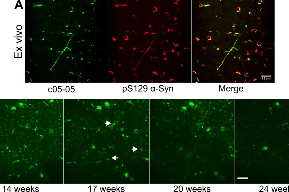 Visual cortical dysfunction